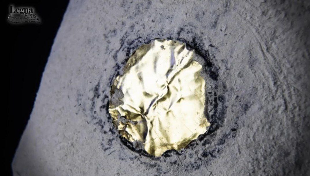 Montserrat Implant